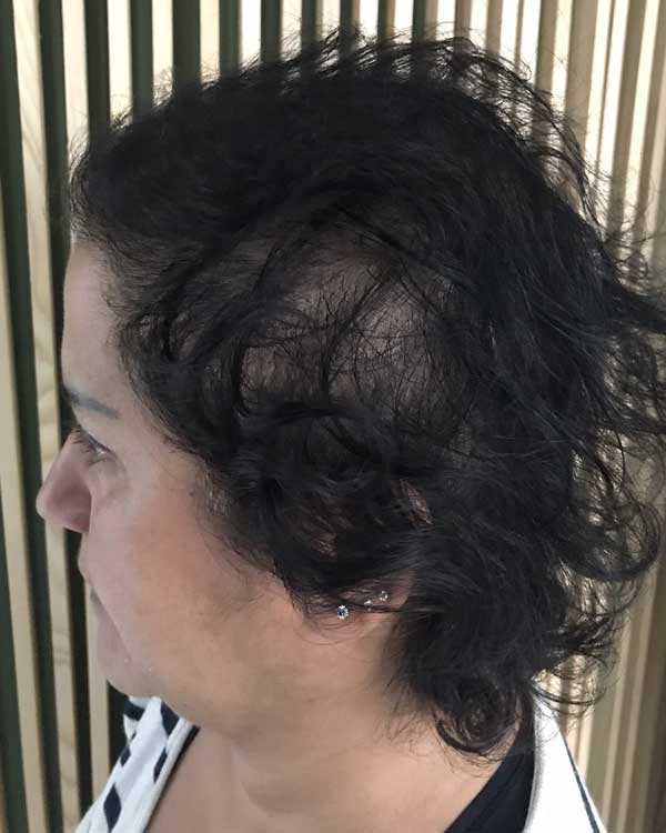 La pelade de cheveux chez la femme : causes et solutions - HRS