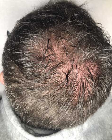 L'alopécie chez l'homme : Causes et Solutions - Hair Repair