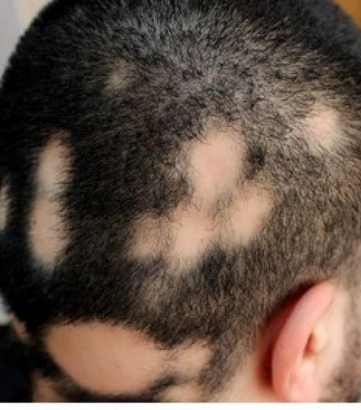 La pelade de cheveux chez l'homme : causes et solutions - HRS