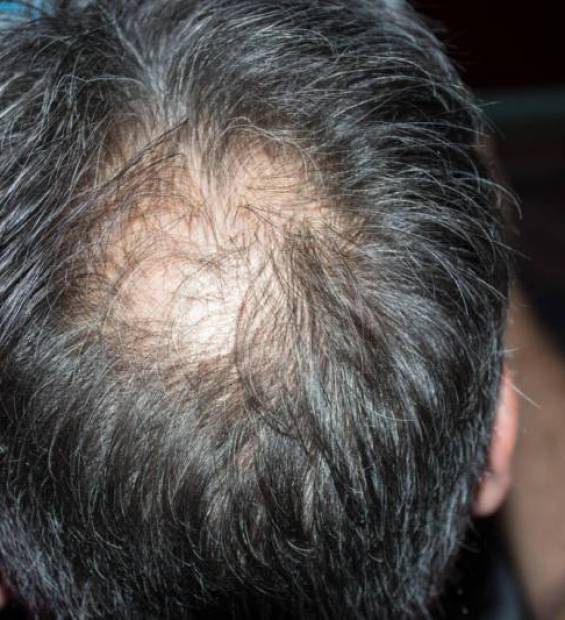 La calvitie vertex : causes et solutions - Hair Repair