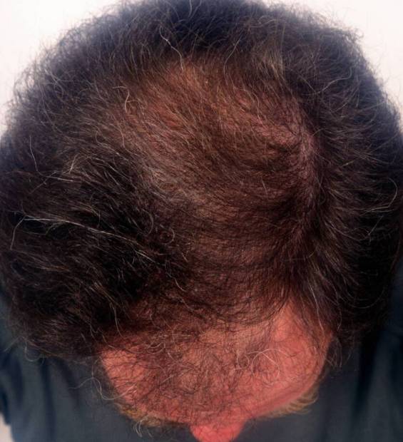 Les cheveux clairsemés chez l'homme : causes et solutions - HRS